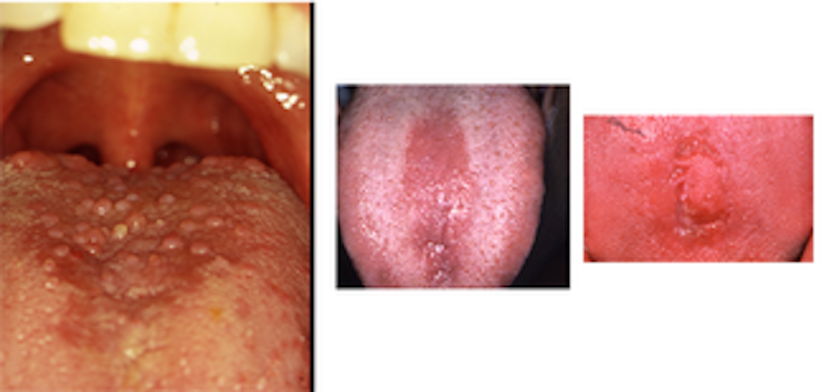 Median Rhomboid Glossitis Registered Dental Hygienist Rdh Magazine