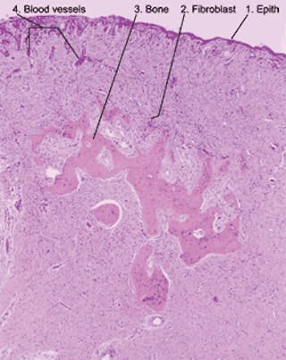 peripheral ossifying fibroma histology