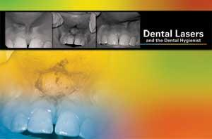 Dental Lasers And The Dental Hygienist Registered Dental Hygienist Rdh Magazine