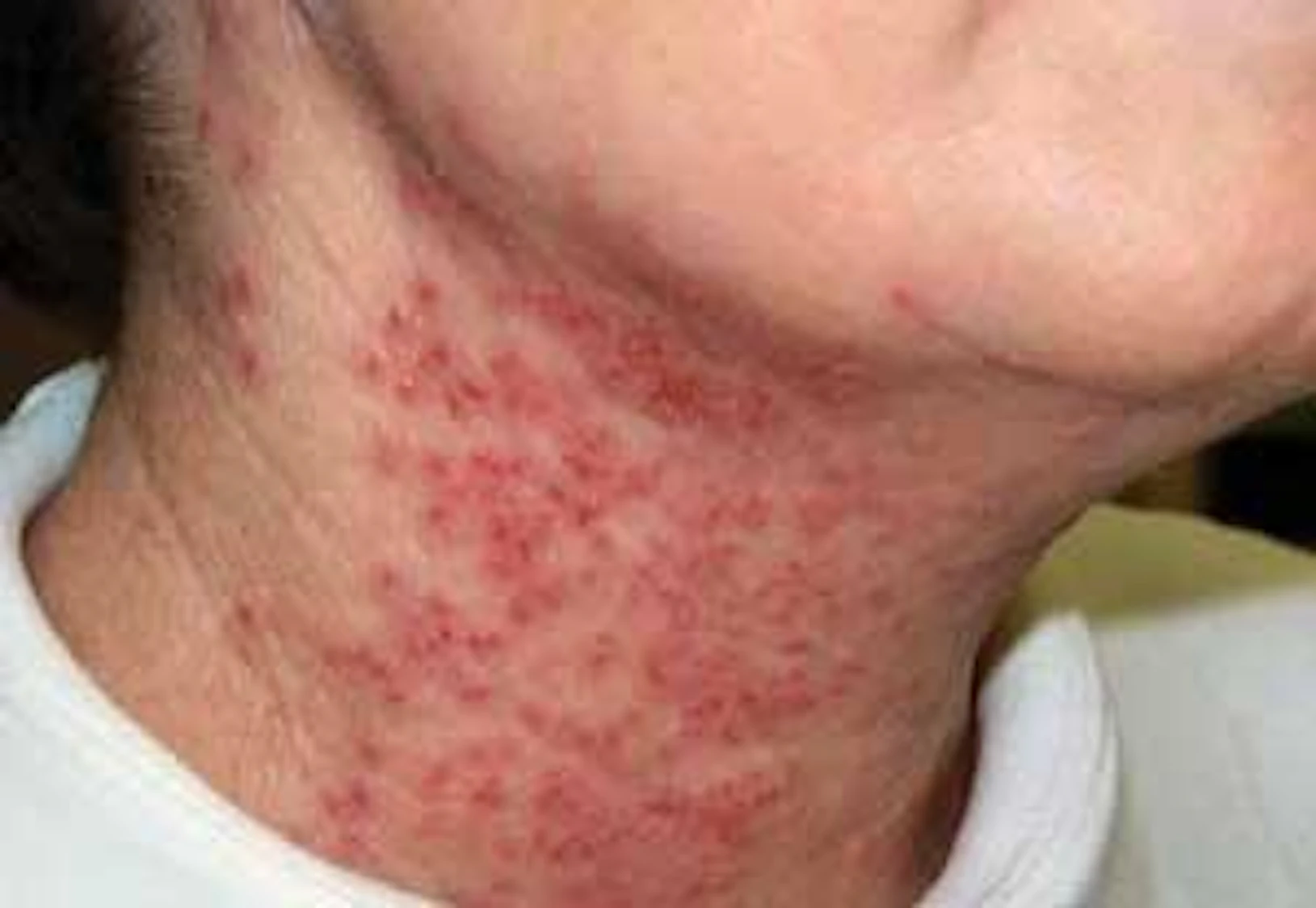 Shingles Registered Dental Hygienists Shingles registered dental hygienists