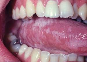 leukoplakia tongue histology