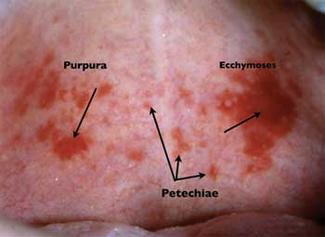 Petechiae Ecchymoses Or Purpura Registered Dental Hygienist Rdh Magazine Petechiae Ecchymoses Or Purpura Registered Dental Hygienist Rdh Magazine