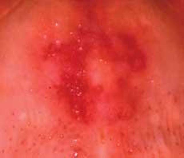 Petechiae, ecchymoses, or purpura? Registered Dental Hygienist