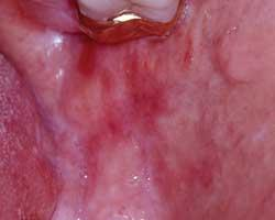 Get Petechiae Ecchymoses Or Purpura Registered Dental Hygienist For Android Free Wallpaper Petechiae Ecchymoses Or Purpura Registered Dental Hygienist For Android Free
