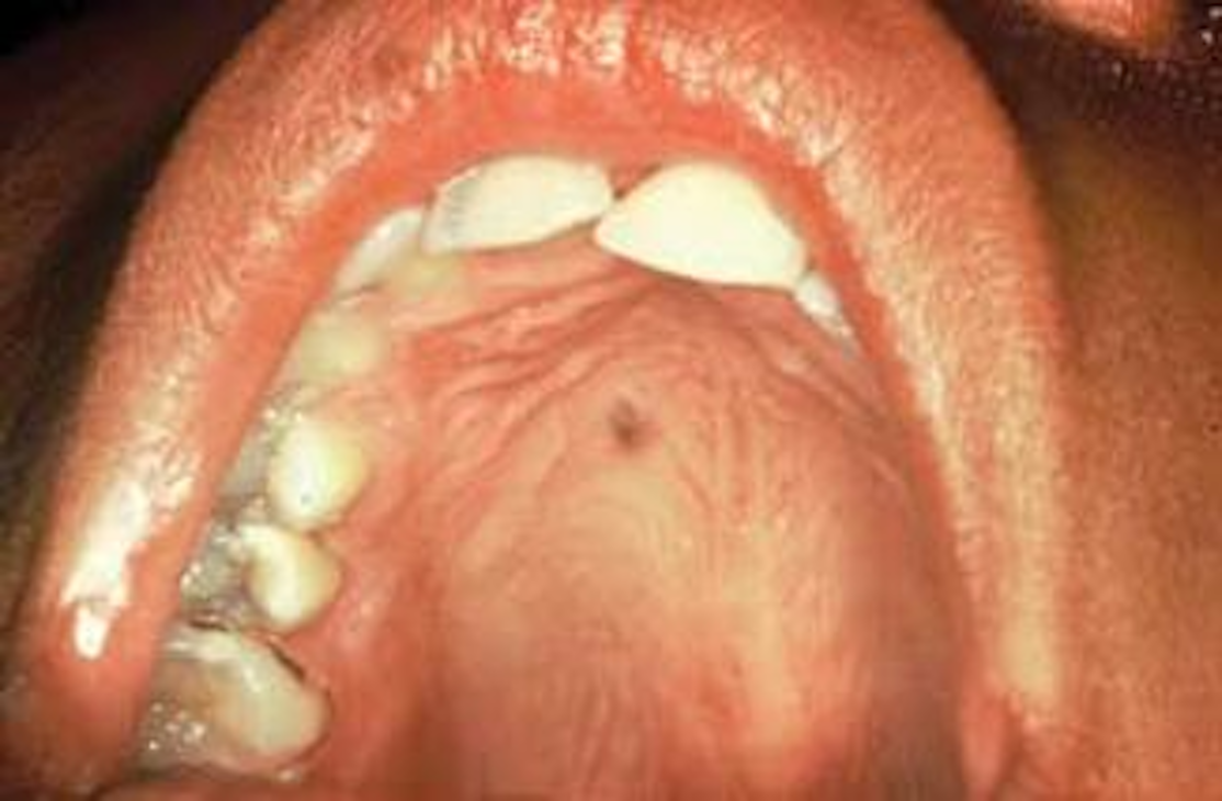 30+ Malignant Melanoma Roof Of Mouth Background