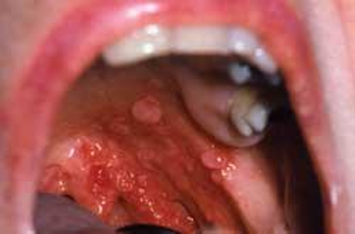 Acid reflux causes tonsil stones