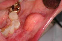 Th Depc Lipoma1 Th Depc Lipoma1