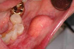 Th Depc Lipoma1 Th Depc Lipoma1