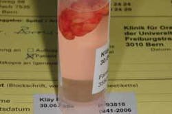 Th Depc Lipoma4 Th Depc Lipoma4