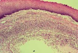 Th Ranula 03 Th Ranula 03