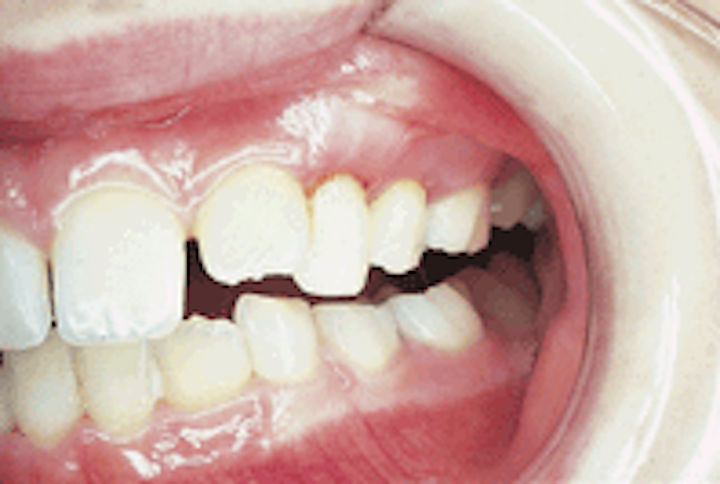 A 9 Year Old Male Visited A Dentists Office For Evaluation Of Bleeding Gums Registered Dental Hygienist Rdh Magazine