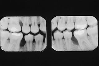 moderate periodontitis radiograph