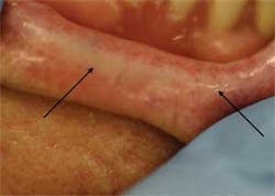 Th Scleroderma 01 Th Scleroderma 01