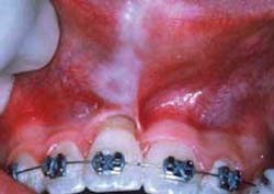 Th Scleroderma 4 Th Scleroderma 4