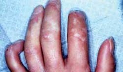 Th Scleroderma 5 Th Scleroderma 5