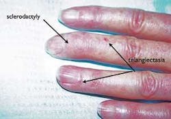 Th Scleroderma 7