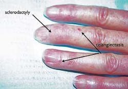 Th Scleroderma 7 Th Scleroderma 7