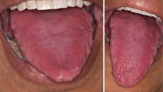 Vitamin B12 Deficiency Symptoms Tongue