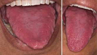 pernicious anemia tongue