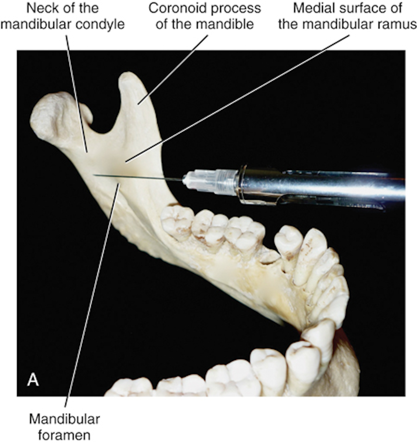 The underused block: The Vazirani-Akinosi mandibular block is a viable ...