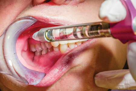 The underused block: The Vazirani-Akinosi mandibular block is a viable ...