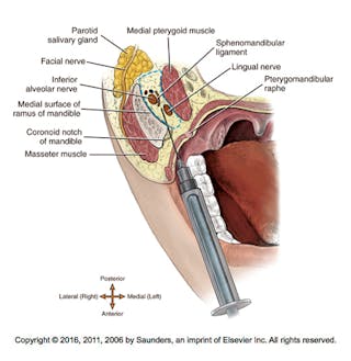 Dental Malpractice Central  Inferior Alveolar Nerve Anatomy