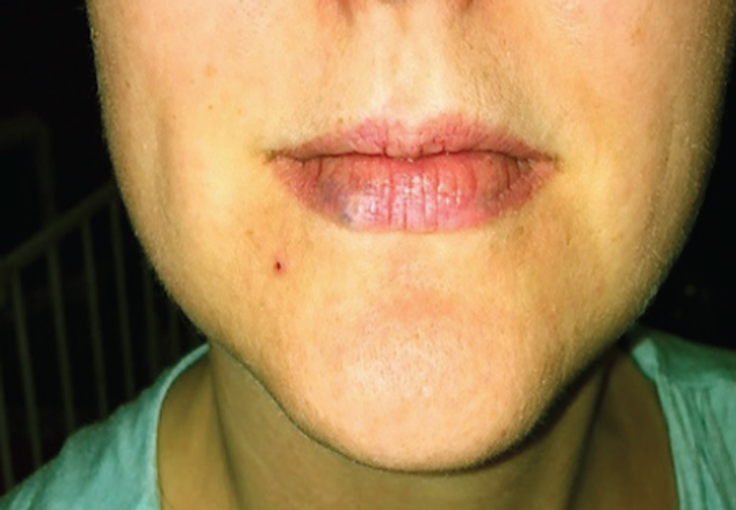 The venous lake Oral pathology diagnosis helps rule out malignant