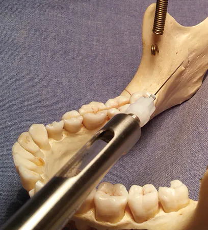 Dental Anesthesia Tips For Successful Mandibular Block Mandibular