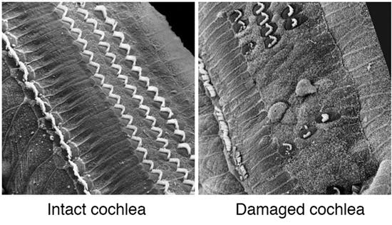Intact cochlea: The photo showing multiple chevron-shaped rows of outer hair cells and a single row of inner hair cells in a healthy cochlea. Damaged cochlea: Extensive loss of outer hair cells and significant damage to the row of inner hair cells. Photo courtesy of House Ear Institute.