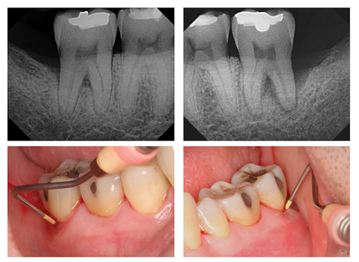 Nonsurgical Attachment Gain A Protocol For Achieving - 