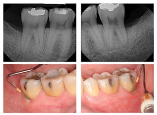 Nonsurgical attachment gain: A protocol for achieving periodontal  reattachment