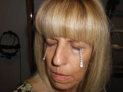 Figure 1: Patient taking the Schirmer Test. The machine to the left of the patient is used for another test called 'Slit Lamp Biomicroscopy' used by ophthalmologists and researchers. Figure 1: Patient taking the Schirmer Test. The machine to the left of the patient is used for another test called 'Slit Lamp Biomicroscopy' used by ophthalmologists and researchers.