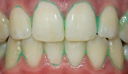 dental plaque disclosed