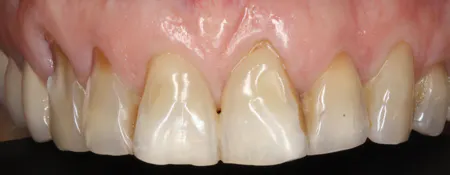 Toothpaste Rda Back Protected by a safe RDA: Setting the record straight about toothpaste ...
