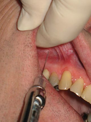 Anesthesia Tips: Hygienists have the experience to deliver comfortable ...