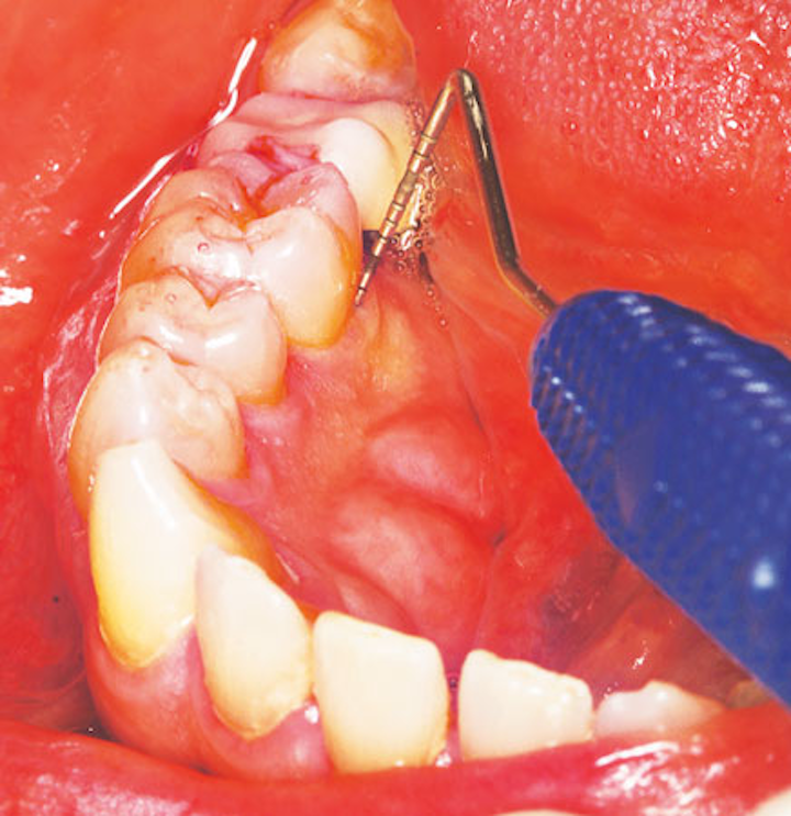 Manage Repair Or Regenerate Periodontal Disease Registered Dental Hygienist Rdh Magazine