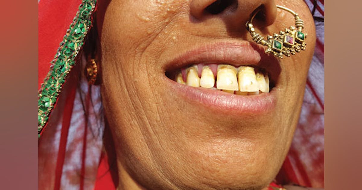 Choumps and cultural tooth tattoos Gold adornments penetrate