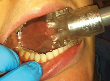 High Volume Evacuation Aerosols It S What You Can T See That Can Hurt You Registered Dental Hygienists