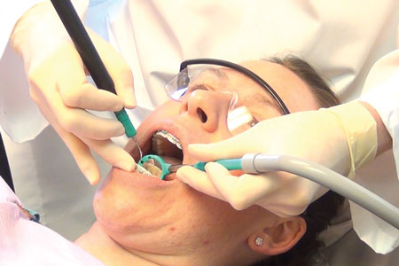 High Volume Evacuation Aerosols It S What You Can T See That Can Hurt You Registered Dental Hygienist Rdh Magazine