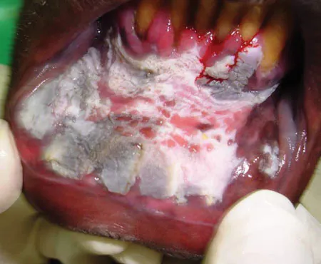 chewing tobacco gum disease from Smoking: Causes and Solutions Smoking and Your Gums -