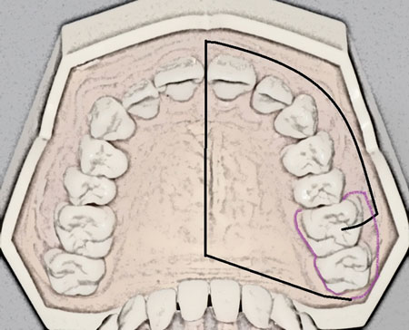 maxillary nerve block high tuberosity approach