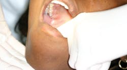 Palpation of salivary glands and floor of the mouth.