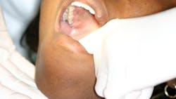 Palpation of salivary glands and floor of the mouth. Palpation of salivary glands and floor of the mouth.