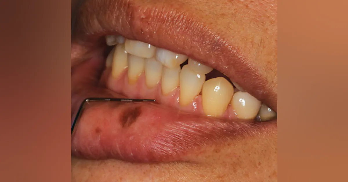 Oral pathology: Noting a pigmented macule that often presents a diagnostic dilemma | Registered Dental Hygienists Oral pathology: Noting a pigmented macule that often presents a diagnostic dilemma | Registered Dental Hygienists