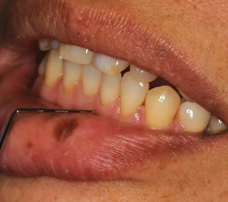 macule melanotic Oral Macule: Symptoms and Treatment Melanocytic Lesions | A Guide