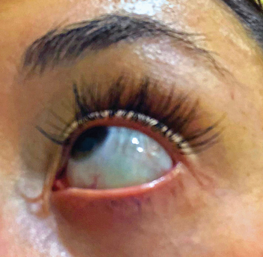 Figure 1: Ocular involvement noted in the eye. Courtesy of Carol Perkins, RDH, BA, AS.