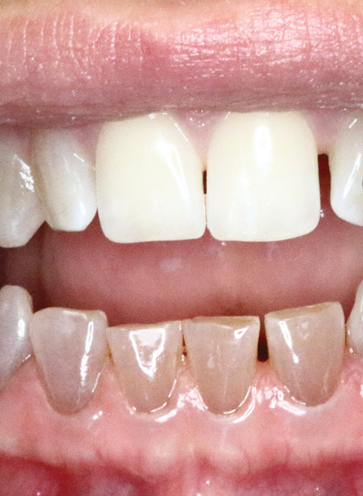 Implication of brittle bone diseases Registered Dental Hygienist (RDH) Magazine