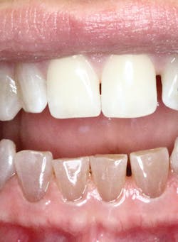 Figure 2: Osteogenesis imperfecta. Courtesy of Carol Perkins, RDH, BA, AS. Figure 2: Osteogenesis imperfecta. Courtesy of Carol Perkins, RDH, BA, AS.