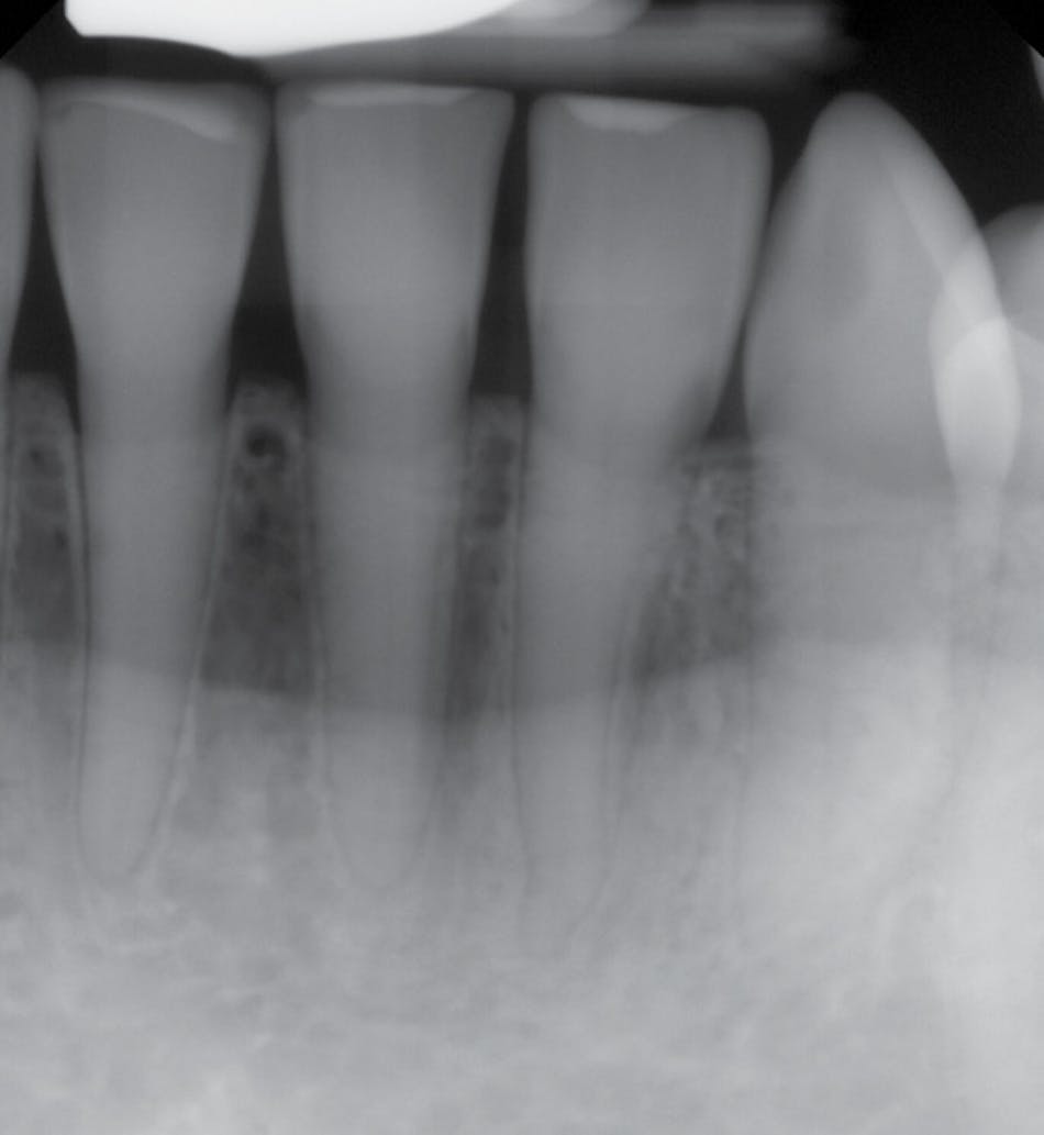 Implication of brittle bone diseases Registered Dental Hygienists