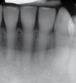 Figure 3: Lower anterior with no pulp. Courtesy of Carol Perkins, RDH, BA, AS. Figure 3: Lower anterior with no pulp. Courtesy of Carol Perkins, RDH, BA, AS.